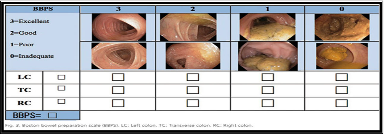 Boston Bowel Preparation Scale (BBPS) - IBS Patient Support Group